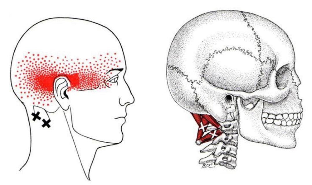 ⚠️Come riconoscere il mal di testa da cervicale e come alleviarlo!